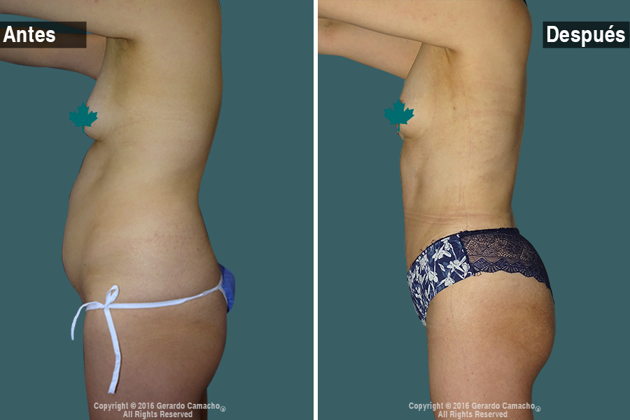 Mejora estética con abdominoplastia en Bogotá